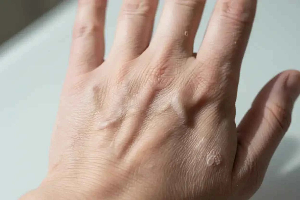 dry-skin-hand - ELOTAK
